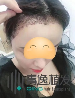 广州青逸植发怎么样？看看这些毛发移植案例你就心里有数了！