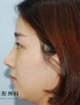韩国句号整形外科隆鼻案例