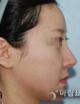 韩国句号整形外科隆鼻修复案例图
