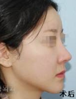 -韩国句号整形外科隆鼻修复日记图