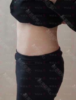  韩国WIZ&美整形医院腰腹迷你吸脂恢复期各阶段效果图分享