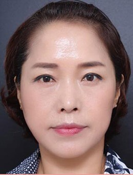 韩国VG百利酷整形医院，面部拉皮手术前后对比案例公布!