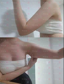 韩国WIZ&美整形外科医院超声波弹力吸脂瘦手臂的经历分享_术前