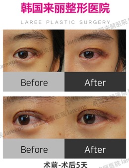 -韩国来丽laree整形外科割双眼皮术后1-5天恢复过程图