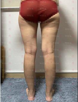 在韩国WIZ&美整形外科做大腿超声波吸脂手术全过程图文分享_术前