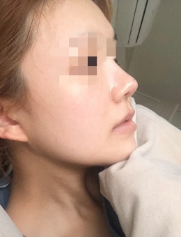 -韩国VG百利酷整形医院3D-CT隆鼻修复整形手术案例