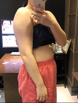 韩国Signature医院手臂副乳吸脂改善效果对比_术前