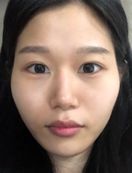 -韩国丽珍整形外科面部轮廓手术案例效果展示！