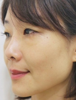 韩国陈整形外科自体真皮再生术治疗法令纹真人案例！_术前