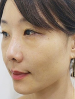 韩国陈整形外科自体真皮再生术治疗法令纹真人日记！