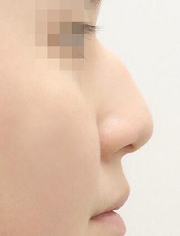 驼峰鼻凸起严重怎么矫正？看看韩国note整形如何轻松变翘鼻！