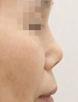 -韩国NOTE整形外科朝天鼻修复案例，解决漏鼻孔需注意这一点！