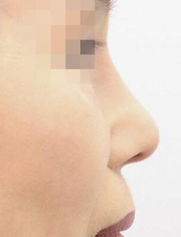 韩国NOTE整形外科朝天鼻修复日记，解决漏鼻孔需注意这一点！_术后