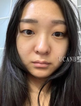 韩国Ucanb整形外科眼鼻整形+玻尿酸丰唇案例对比！_术前