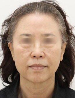 提升抗衰老有没有效果，韩国note整形真人案例揭秘！