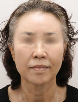 -提升抗衰老有没有效果，韩国note整形真人案例揭秘！