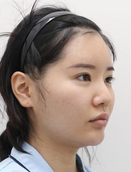 在韩国note整形外科做颧骨缩小鼻矫正改善经历！_术前