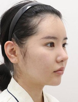 在韩国note整形外科做颧骨缩小鼻矫正改善经历！_术后