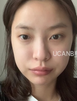-韩国Ucanb整形外科眼型矫正+脂肪填充真人案例展示！
