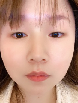 韩国Ucanb整形外科双眼皮真人案例效果图！_术前