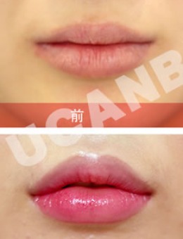 韩国Ucanb整形外科玻尿酸丰唇案例效果对比图！