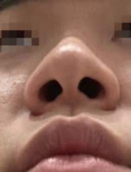 -韩国Ucanb整形外科鼻翼缩小术后效果图！