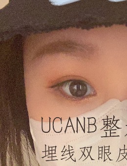 韩国UcanB整形外科埋线双眼皮案例效果图！_术后