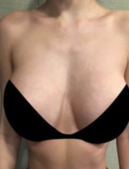 韩国麦恩整形外科隆胸修复真人案例对比图！