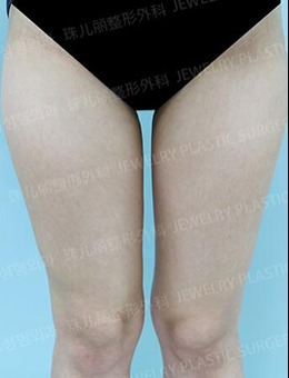 韩国珠儿丽整形外科大腿吸脂前后对比照片_术前