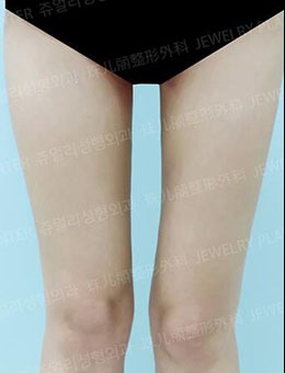 -韩国珠儿丽整形外科大腿吸脂前后对比照片