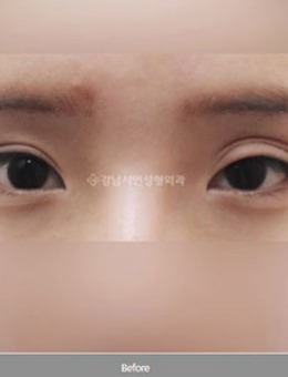 双眼皮宽变窄手术治疗案例