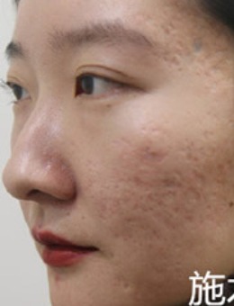 韩国陈整形外科去除凹陷疤痕三天后皮肤照片展示！_术前