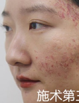 韩国陈整形外科去除凹陷疤痕三天后皮肤照片展示！_术后