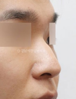 严重驼峰鼻矫正治疗案例图片