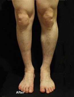 一边腿粗一边腿细的不对称腿型，在韩国JS美医院矫正成功！