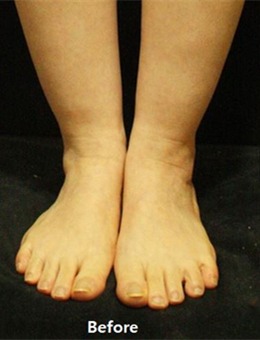 脚脖子脂肪多？这组韩国JS美医院脚踝吸脂手术前后图片了解一下_术前