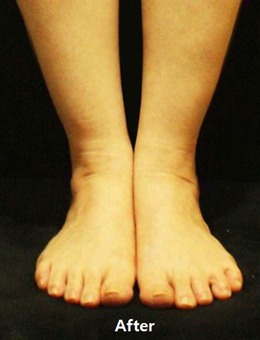 脚脖子脂肪多？这组韩国JS美医院脚踝吸脂手术前后图片了解一下_术后