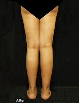 韩国JS美医院x型腿矫正手术原理解析，真实效果如图！