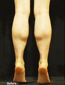 韩国JS美医院小腿整形手术病例图片分享_术前