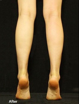 韩国JS美医院小腿整形手术病例图片分享_术后