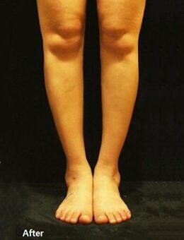 小腿、脚踝吸脂手术亲测有效！后悔没有早在韩国JS美医院做！