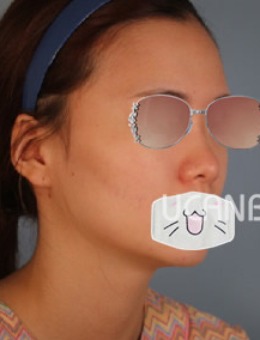韩国Ucanb整形外科假体隆鼻真人案例展示！