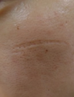 韩国陈整形外科改善面部凹陷疤痕真人效果图！
