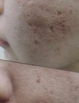 韩国陈整形外科改善面部痘坑，凹陷疤痕真人案例对比图！