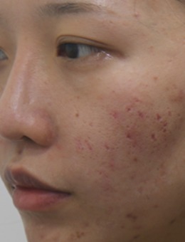 -韩国陈整形外科改善面部痘坑，凹陷疤痕真人案例对比图！