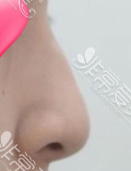 -韩国优雅人初鼻整形手术前后对比案例