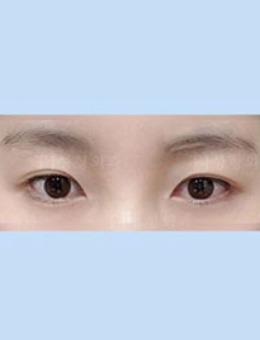 韩国TJ整形医院双眼皮案例照片