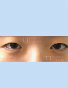-韩国TJ整形医院双眼皮+内眦赘皮矫正案例前后对比