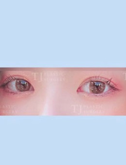 韩国TJ整形医院双眼皮+内眦赘皮矫正案例前后对比