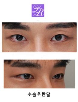 韩国双眼皮改单眼皮有成功的吗？有！这位男士术后效果自然还无疤！_术后
